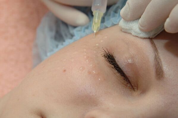 Mesoterapia un método de inyección para el rejuvenecimiento de la piel facial