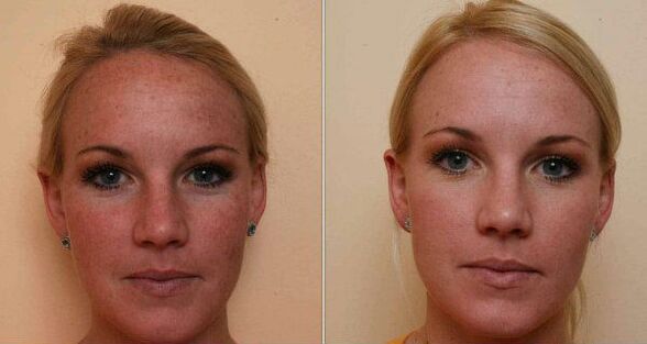 antes y después del rejuvenecimiento de la piel facial con láser