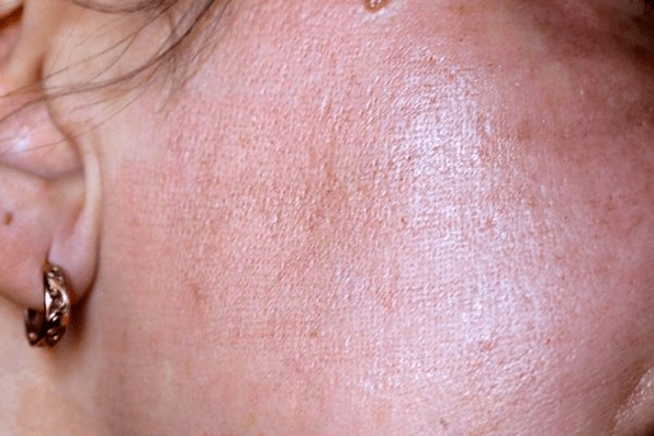 enrojecimiento de la piel después del rejuvenecimiento con láser