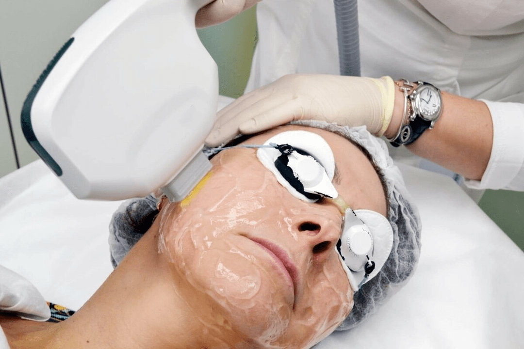 rejuvenecimiento con láser para la piel del rostro