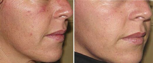 rostro antes y después del rejuvenecimiento de la piel con hardware